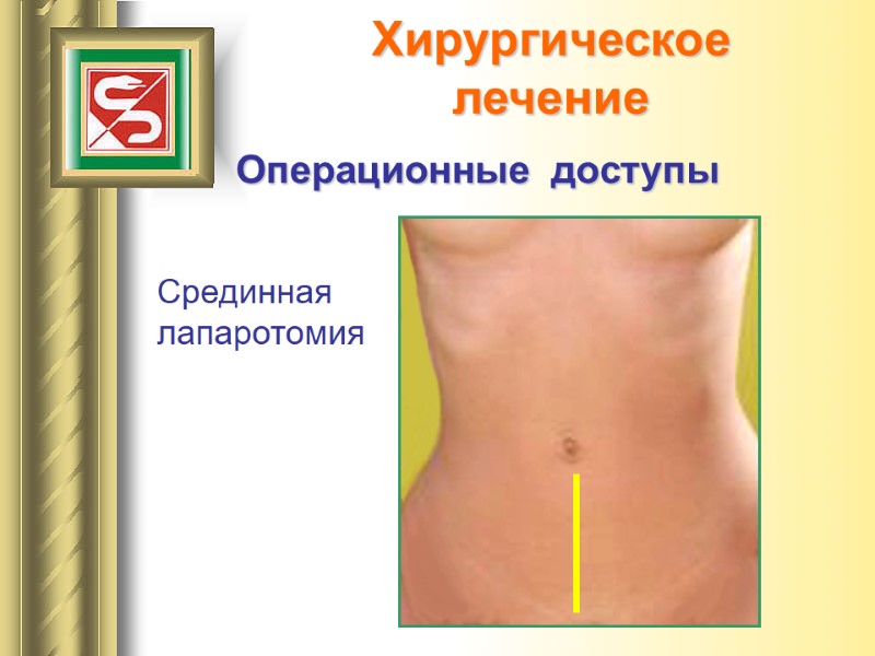 Хирургическое  лечение  Срединная лапаротомия Операционные  доступы